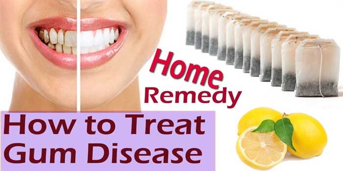 Home Remedies to Prevent Gum Bleeding Naturally