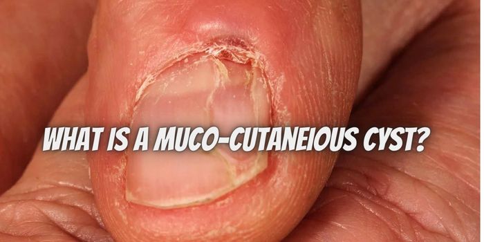 What Is A Muco-Cutaneious Cyst