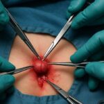10 Things Not to Do After Piles Surgery Your Complete Guide to Recovery